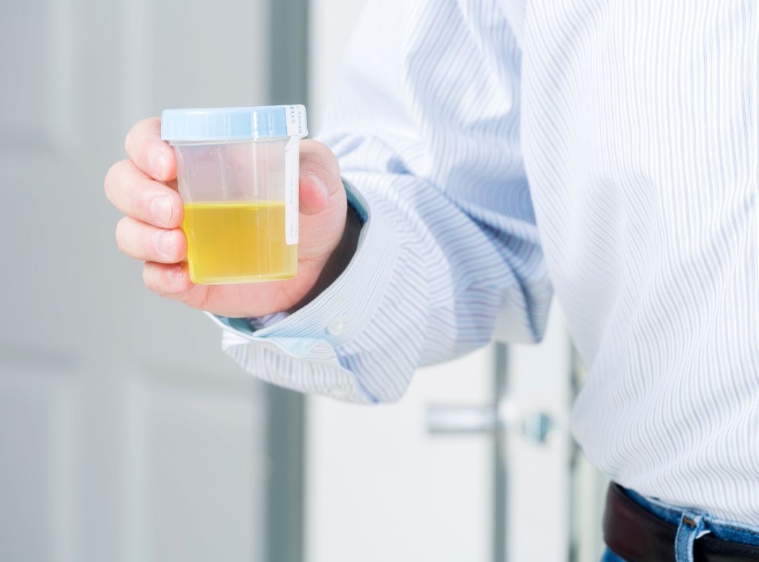 Urine mousseuse