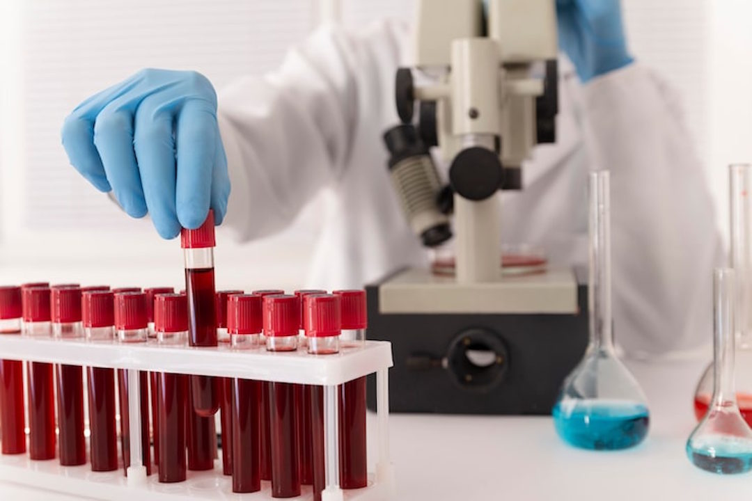 Analyse de sang pour les lymphocytes