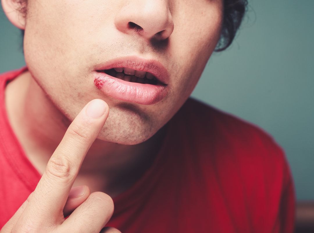 herpès labial : bouton de fièvre