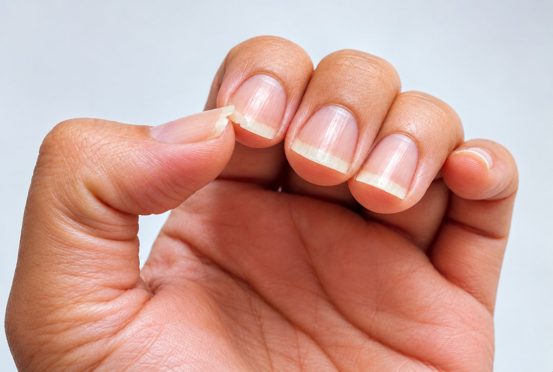 Un ongle qui est cassée