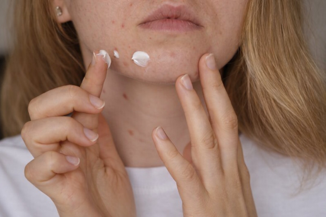 Une femme qui applique une crème sur les acnés sévères