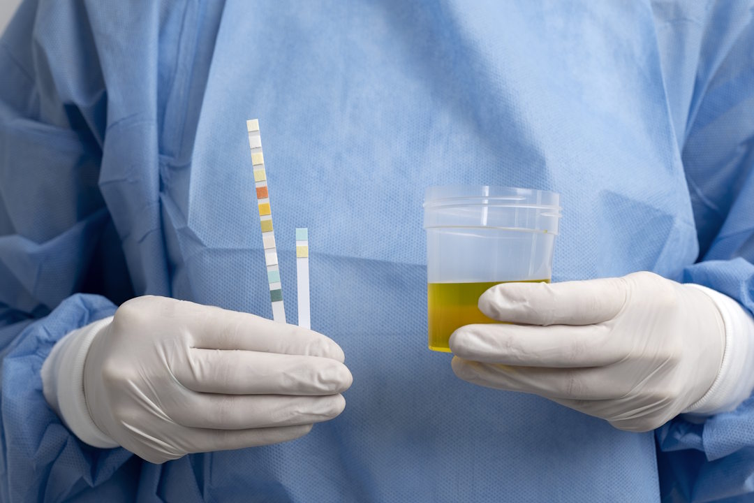 Glycosurie et test par bandelette urinaire
