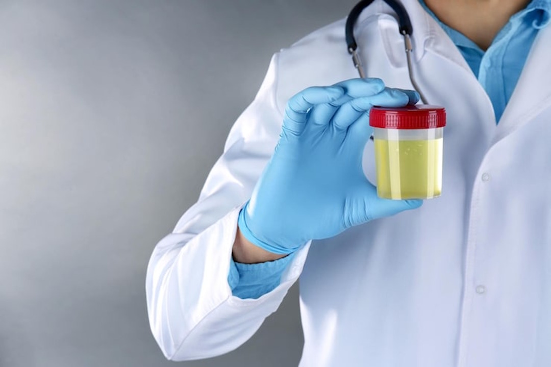 Des leucocytes dans les urines 