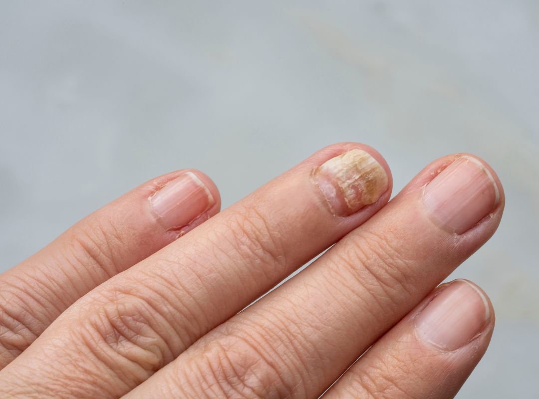 Mycose des ongles
