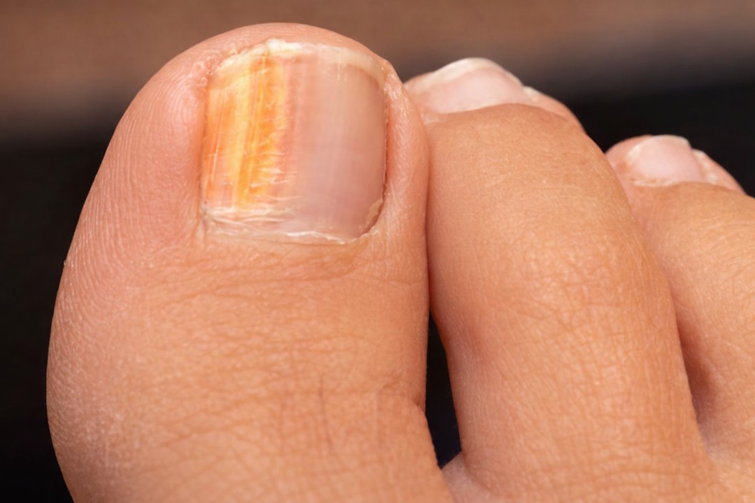 La mycose des ongles (onychomycose)