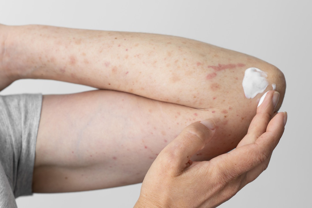 Une personne qui applique une crème antibiotique