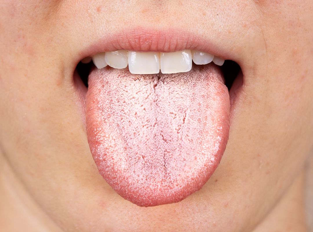 Causes de la  mycose langue