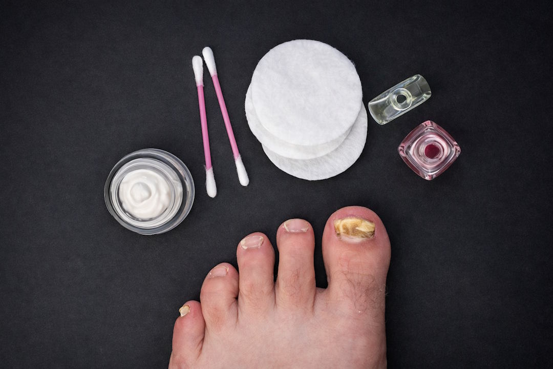 Traitement de la mycose des ongles