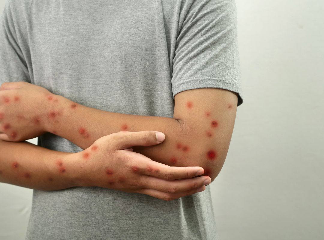 Varicelle symptômes ado
