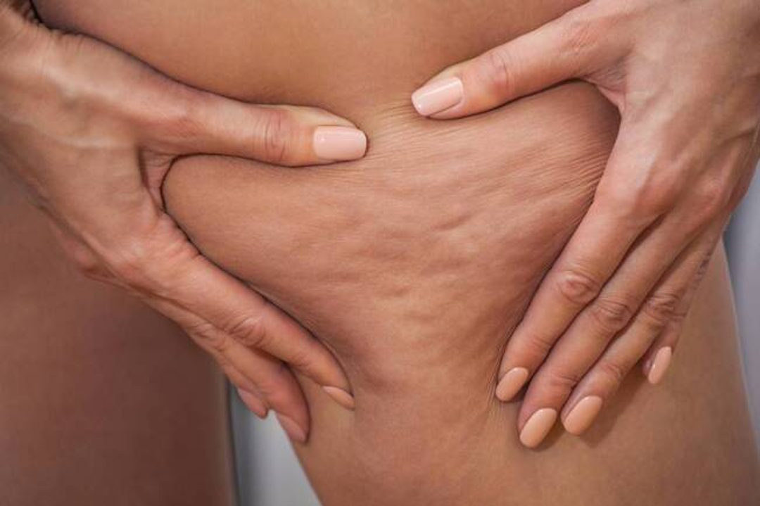 Peau d'orange et cellulites
