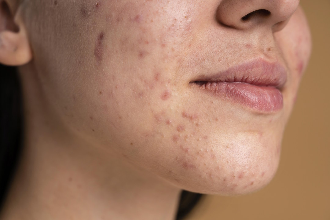 Une femme avec des problèmes d'acnés sur  le visage