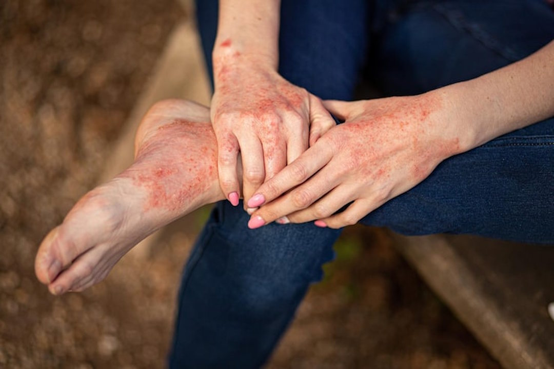 Une personne qui souffre de dermatite