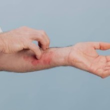 Eczéma et stress : comment le stress peut-il aggraver les poussées ?