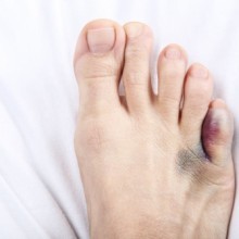 Orteil cassé : comment reconnaître et soigner une fracture ?