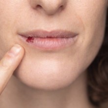 Bouton de fièvre : causes, symptômes et traitements de l'herpès labial