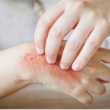 Mycose : causes, signes et traitements