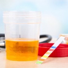 Urine foncée : quelles sont les causes et comment réagir ?