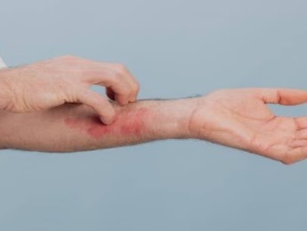 Eczéma et stress : comment le stress peut-il aggraver les poussées ?