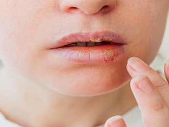 Herpès : symptômes, causes et traitements des poussées virales