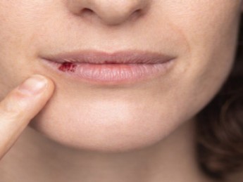Bouton de fièvre : causes, symptômes et traitements de l'herpès labial
