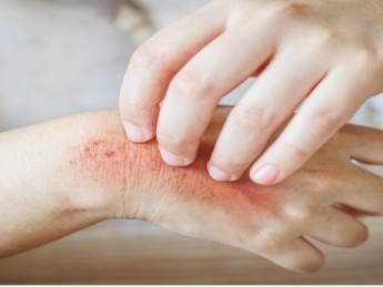 Mycose : causes, signes et traitements