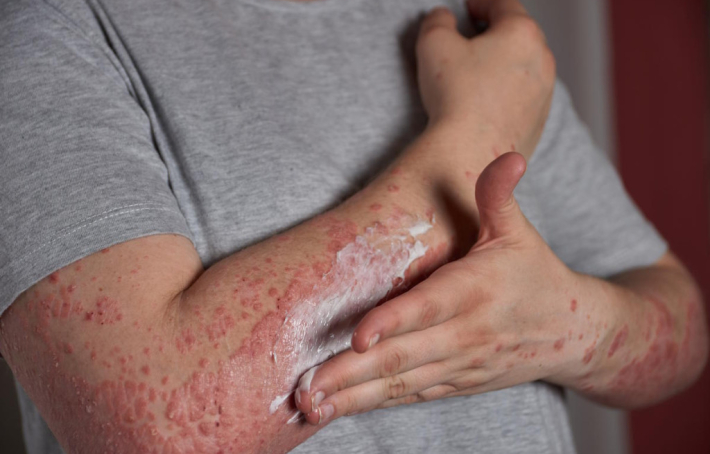 Eczéma, urticaire, boutons : comment le stress agit sur votre peau ?