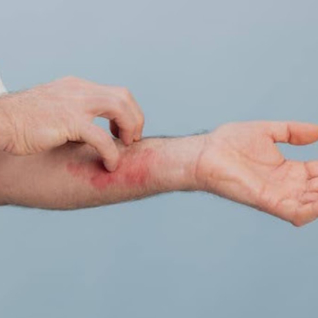 Eczéma et stress : comment le stress peut-il aggraver les poussées ?