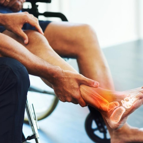 Arthrose cheville : symptômes, causes et solutions pour soulager la douleur