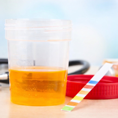 Urine foncée : quelles sont les causes et comment réagir ?