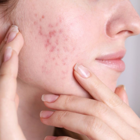 Acné fongique : causes, symptômes et traitements de la folliculite