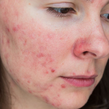 Rosacée : causes, symptômes et traitements de l'acné rosacée
