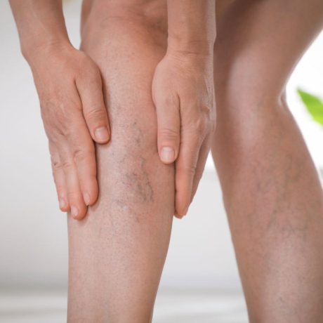 Phlébite : causes, symptômes et traitements