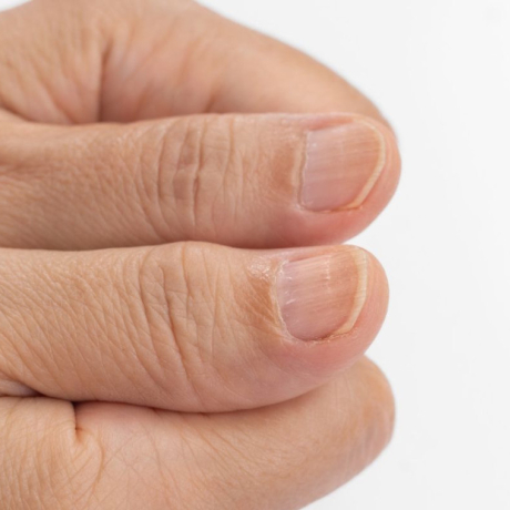 Ongles striés : causes et solutions pour les éviter
