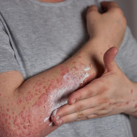 Eczéma, urticaire, boutons : comment le stress agit sur votre peau ?