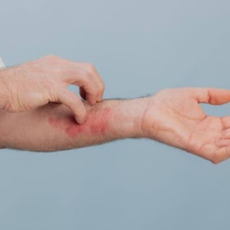 Eczéma et stress : comment le stress peut-il aggraver les poussées ?