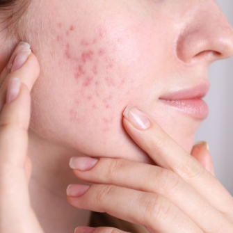 Acné fongique : causes, symptômes et traitements de la folliculite