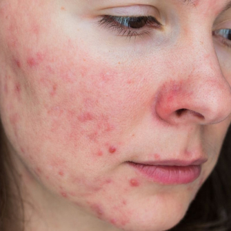 Rosacée : causes, symptômes et traitements de l'acné rosacée