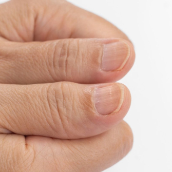 Ongles striés : causes et solutions pour les éviter