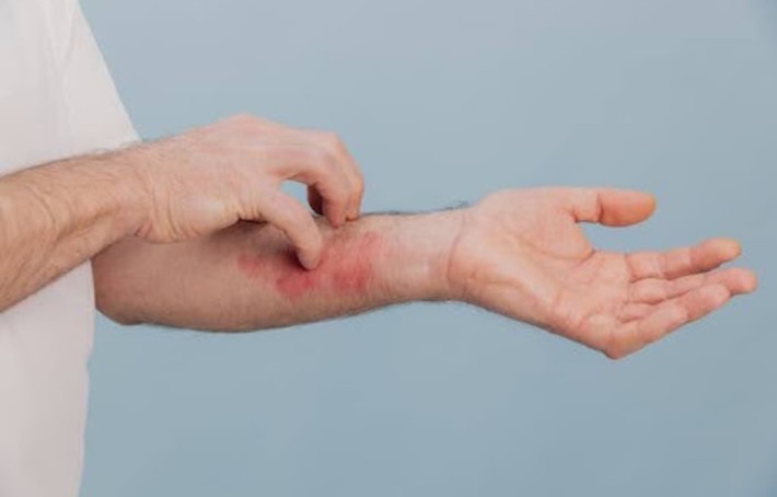 Eczéma et stress : comment le stress peut-il aggraver les poussées ?