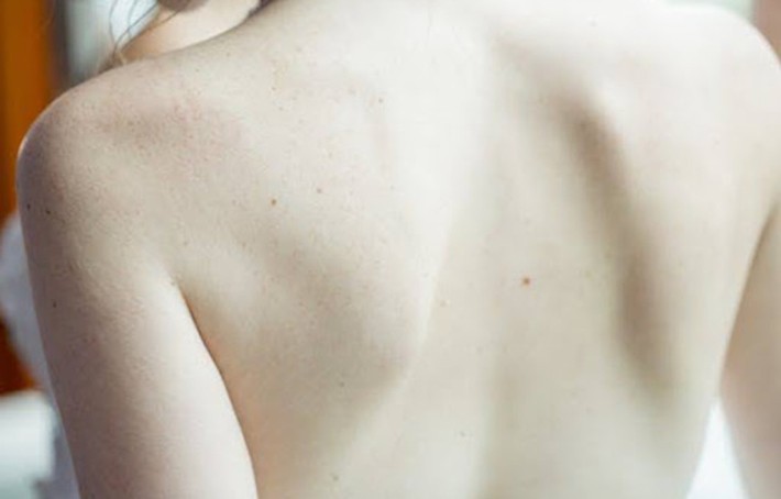 Arthrose inter-apophysaire : symptômes, causes et solutions naturelles