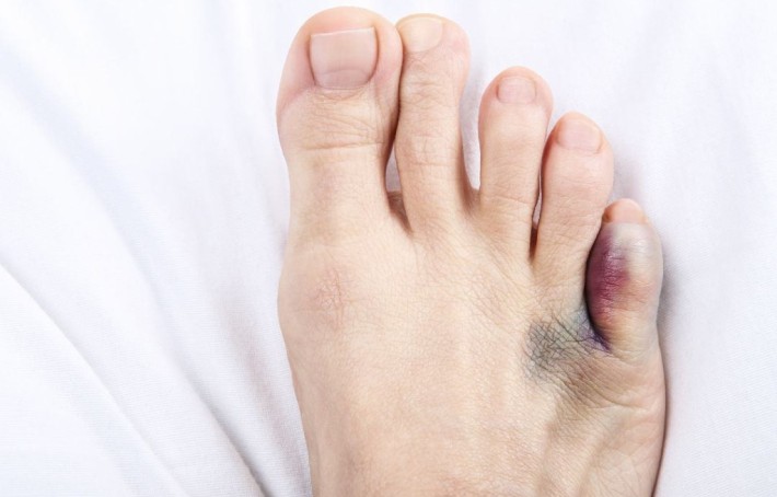 Orteil cassé : comment reconnaître et soigner une fracture ?