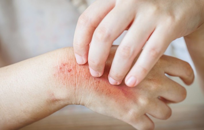 Mycose : causes, signes et traitements