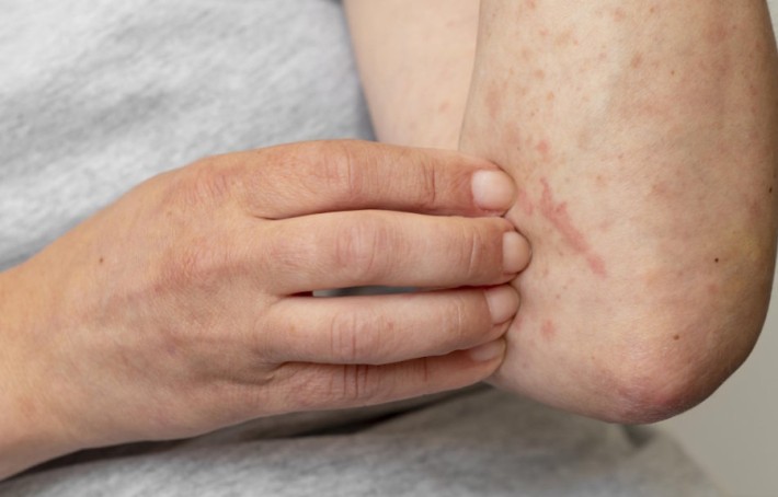 Varicelle : symptômes, causes et traitements chez l'enfant et l'adulte
