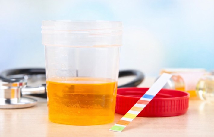Urine foncée : quelles sont les causes et comment réagir ?
