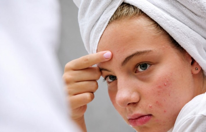 Acné sévère : causes et traitements médicaux