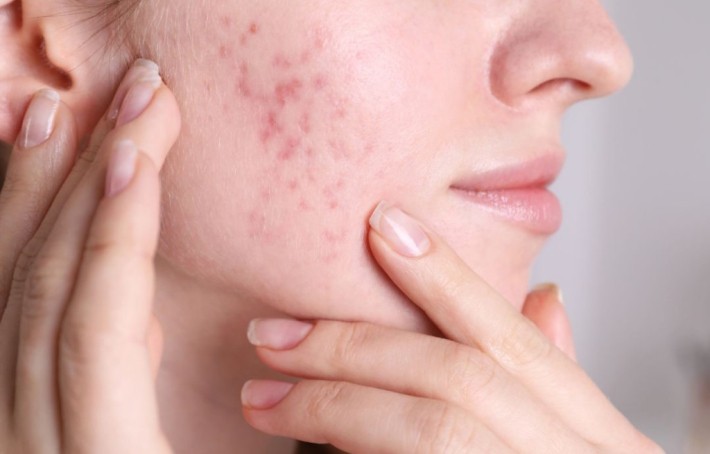 Acné fongique : causes, symptômes et traitements de la folliculite