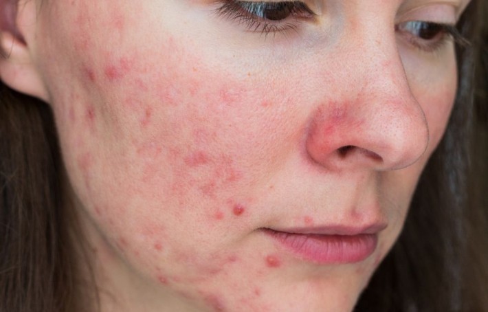 Rosacée : causes, symptômes et traitements de l'acné rosacée