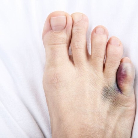 Orteil cassé : comment reconnaître et soigner une fracture ?