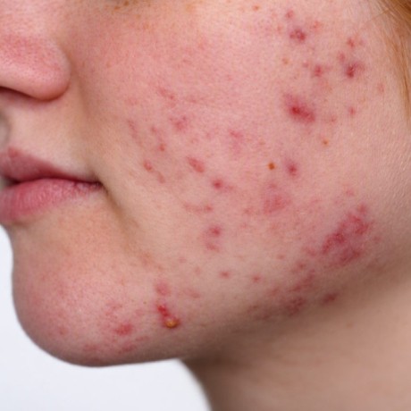 Causes et symptômes de l'acné kystique et solutions pour l'apaiser
