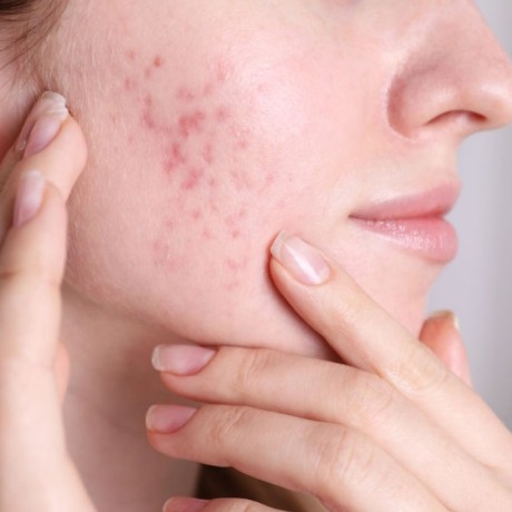 Acné fongique : causes, symptômes et traitements de la folliculite